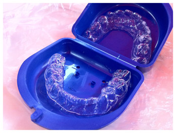celar braces from Mullenbach Dentistry of La Crosse