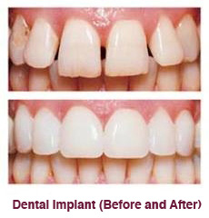 Dental Implant from Mullenbach Dentistry of La Crosse