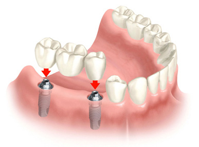 Dental Implant from Mullenbach Dentistry of La Crosse