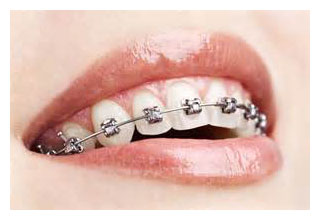 Orthodontic Dentistry from Mullenbach Dentistry of La Crosse