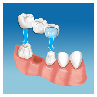 Prosthodontic bridge by Mullenbach Dentistry of La Crosse
