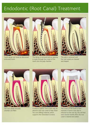 Root Canal Treatment from Mullenbach Dentistry Prentative Dental Care Services